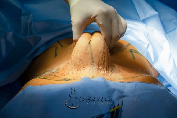 Will stretch marks go away with a tummy tuck? Aesthetic Clinic Turkey Antalya