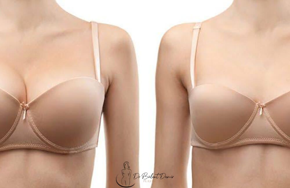 Breast-augmentation-uplift-reduction-antalya-turkey