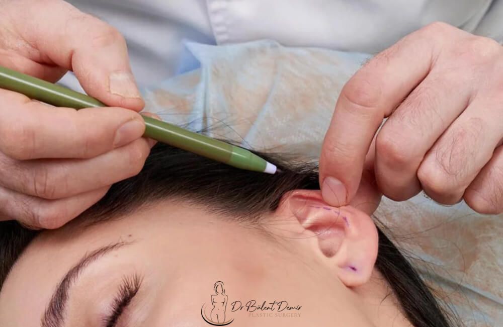 Otoplasty (Ear Surgery) in Turkey