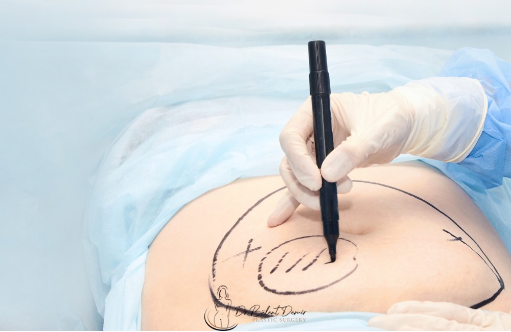 How Much Weight Can Be Lost With Liposuction?