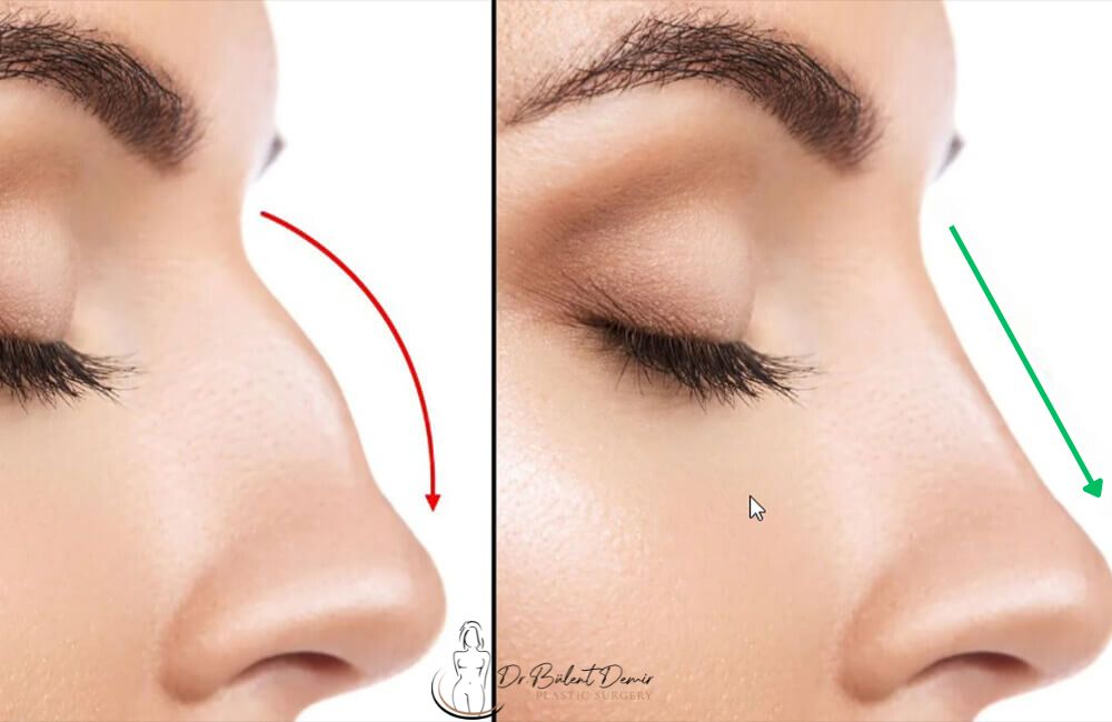 Burun Ameliyatı Antalya Burun Ameliyatı Antalya