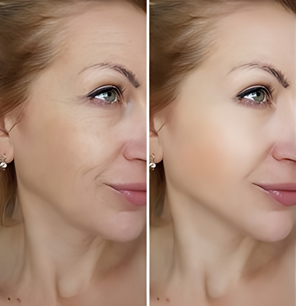 Deep-plane-facelift-before-after Deep-plane-facelift-before-after-Antalya-Turkey