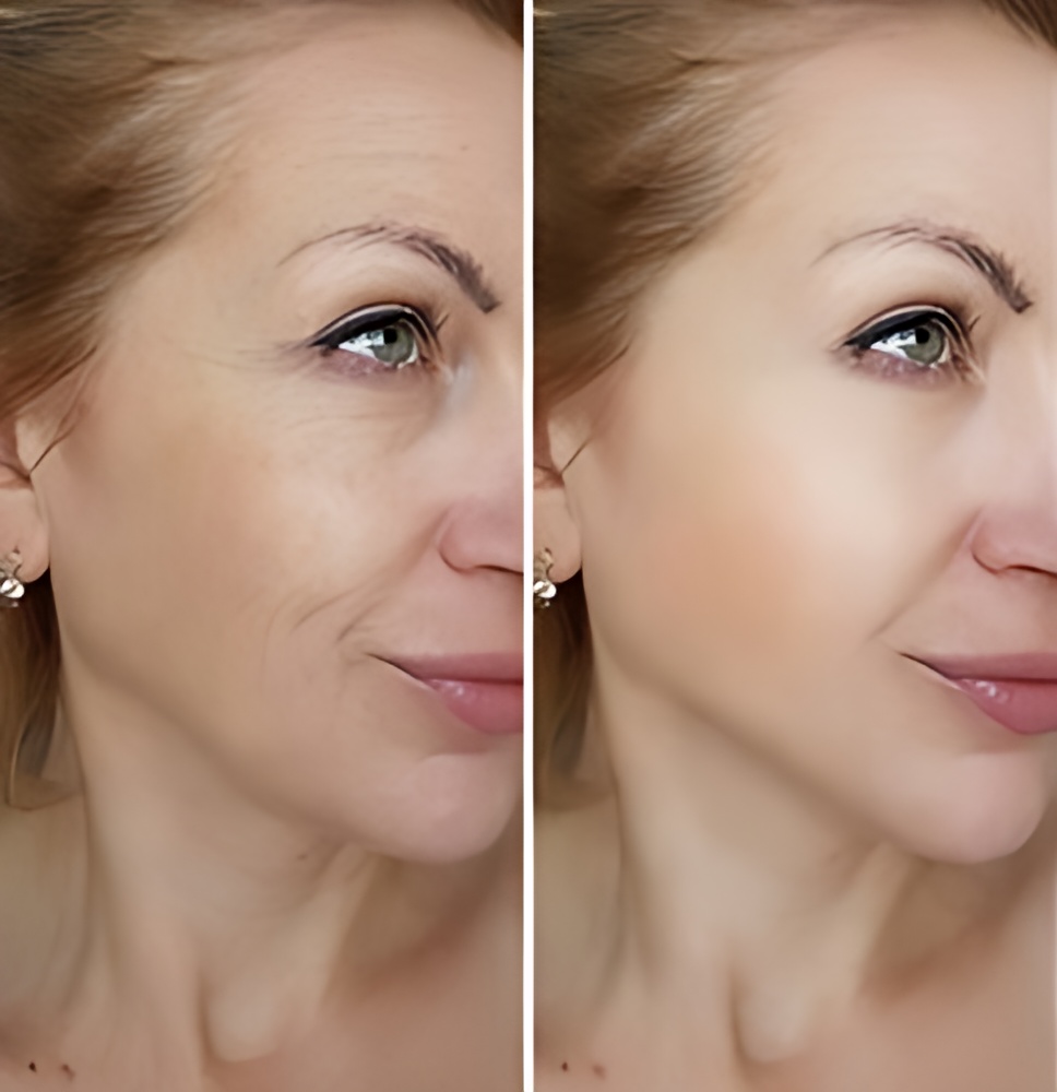 Deep-plane-facelift-before-after-Antalya-Turkey