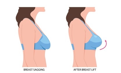 How do you know if you need a boob uplift?-Boob lift before&after in Antalya Turkey