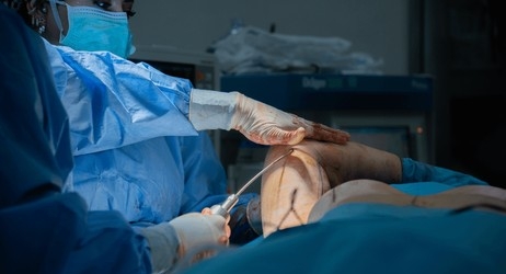 How is arm lift surgery done? How is arm lift surgery done?