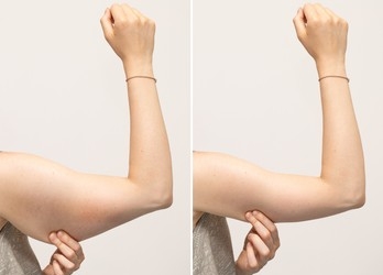 Pros and cons of arm lift in Turkey What are pros and cons of arm lift in Turkey?