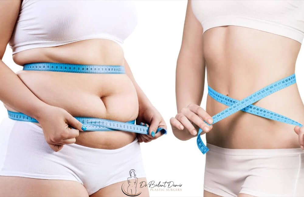 360-Degree Liposuction